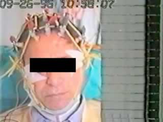Symptomatic epilepsy with facial myoclonic seizures triggered by language