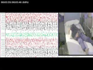 GEFS+ where focal seizures evolve from generalized spike wave: video-EEG study of two children