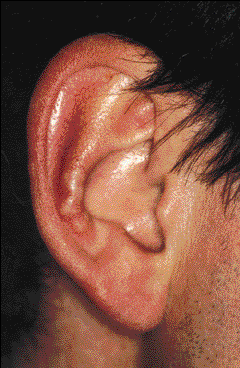 tophi in ear
