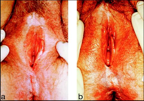 Psoriasis On Vulva