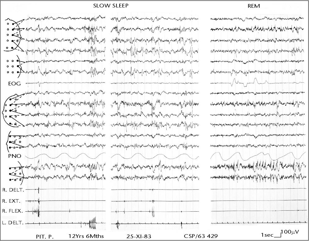 John Libbey Eurotext Epilepsies Progressive Myoclonus Epilepsies In Clinical Practice