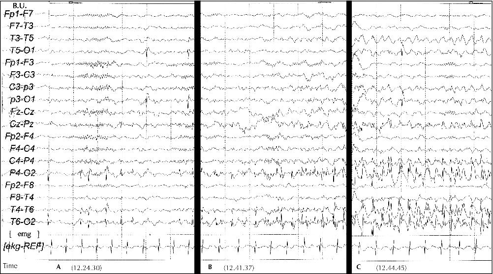 Jle Epileptic Disorders Panayiotopoulos Syndrome Videoeeg