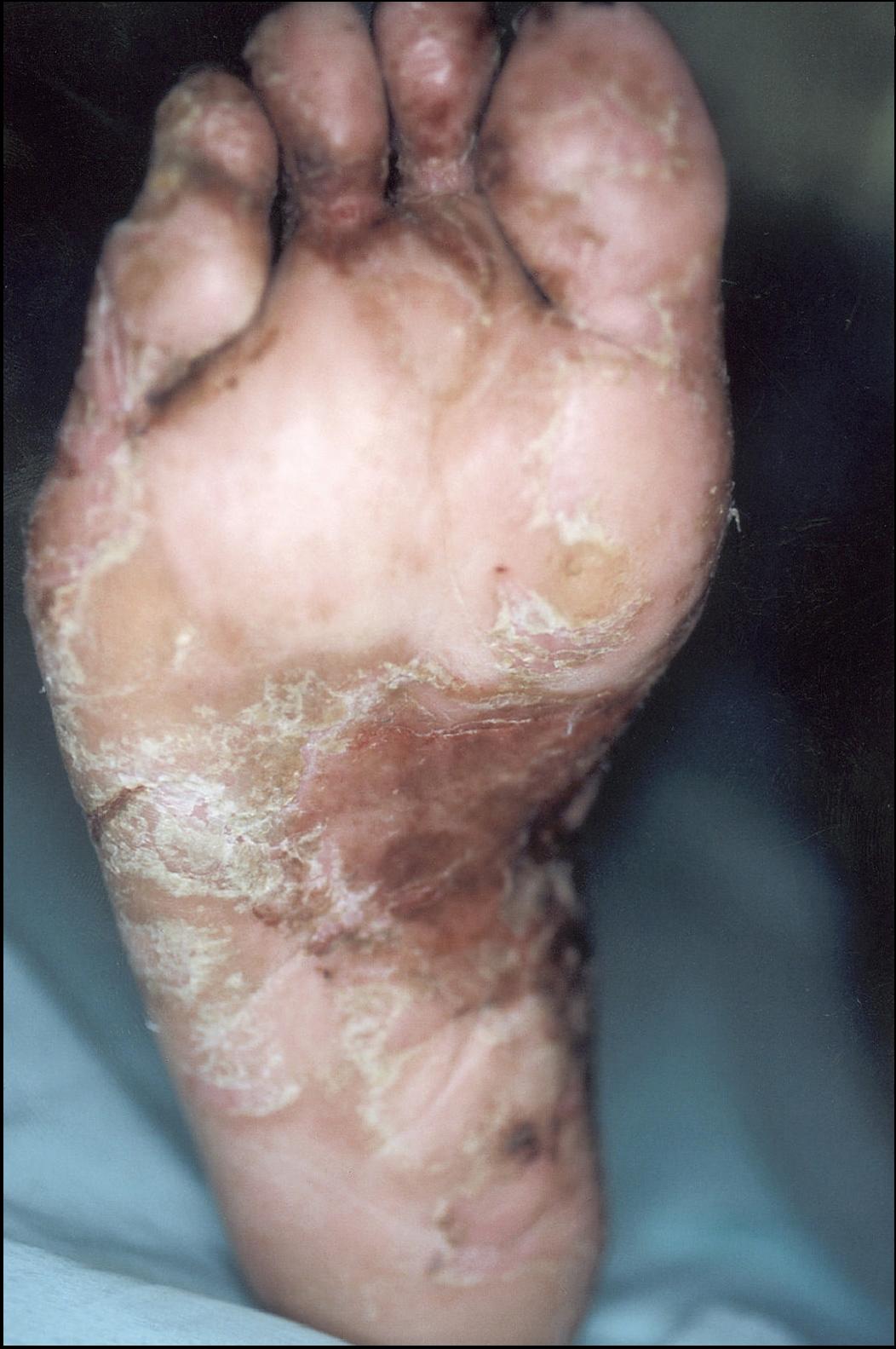 Foot Dermatitis Pictures