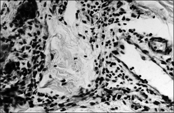 John Libbey Eurotext European Journal Of Dermatology A Clinicopathological Study On Acute Cutaneous Lesions Induced By Sulfur Mustard Gas Yperite