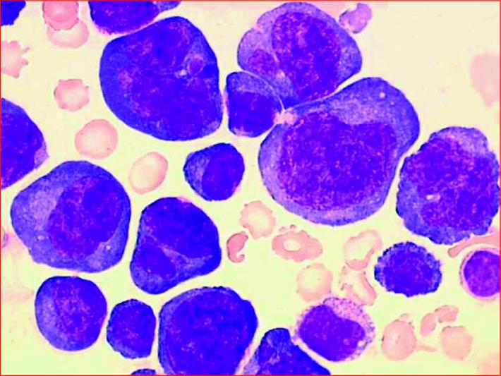 John Libbey Eurotext H Matologie Lymphoproliferative Disorders