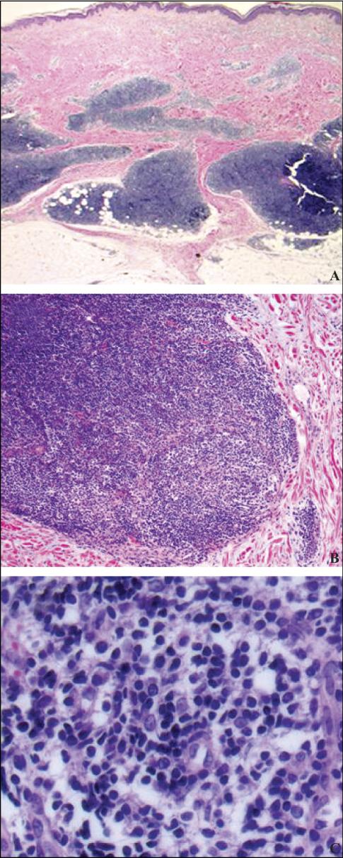 John Libbey Eurotext European Journal Of Dermatology Primary Cutaneous Marginal Zone B Cell Lymphoma