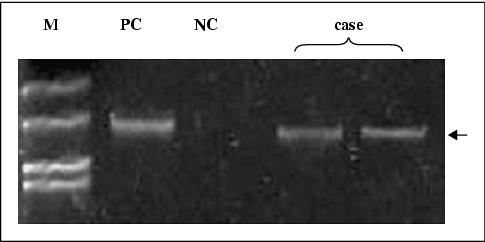 John Libbey Eurotext European Journal Of Dermatology Primary Cutaneous Marginal Zone B Cell Lymphoma