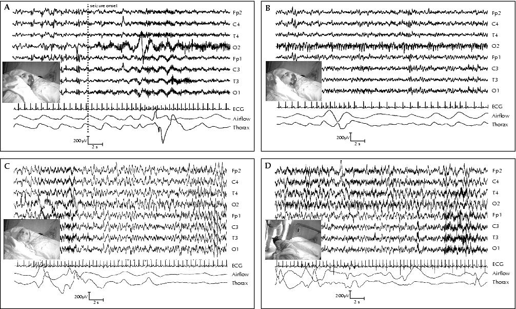 Jle Epileptic Disorders Ictal Video Polysomnography And Eeg