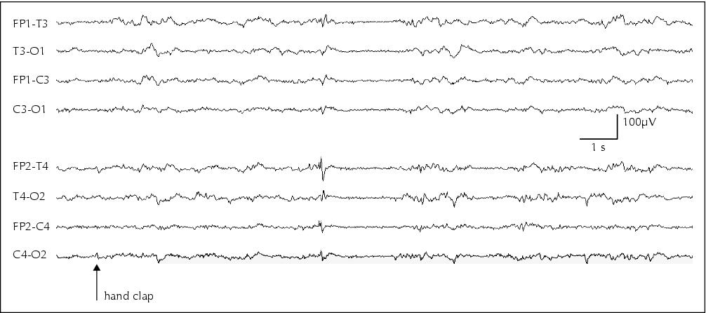 Burst Suppression Eeg