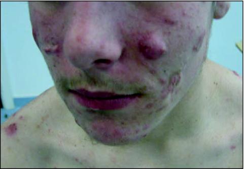 Acne Lesions