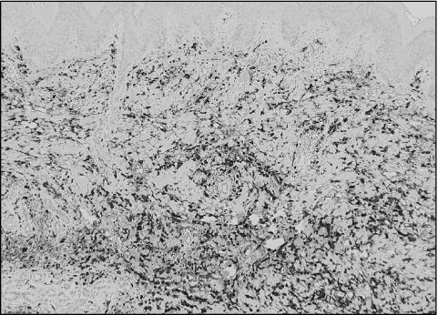 John Libbey Eurotext European Journal Of Dermatology Early Lesion Of Palisaded Neutrophilic Granulomatous Dermatitis In Ulcerative Colitis