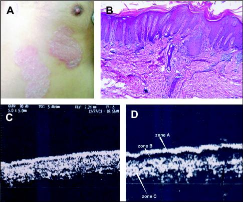 John Libbey Eurotext European Journal Of Dermatology Ultrasound Biomicroscopy In The Diagnosis Of Skin Diseases