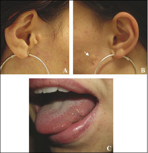 Tongue Skin Tag