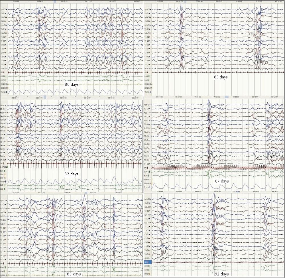 Burst Suppression Eeg