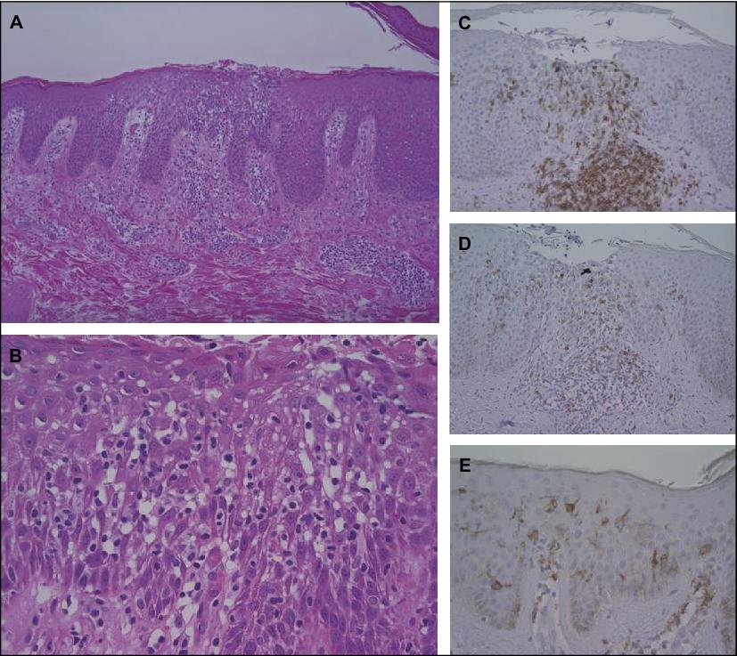 John Libbey Eurotext European Journal Of Dermatology Superimposed Segmental Dermatitis With Chronic Prurigo