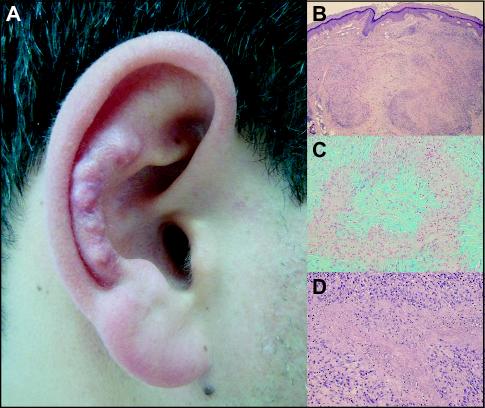 John Libbey Eurotext European Journal Of Dermatology Bilateral Granuloma Annulare Of The External Ear