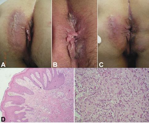 Perianal Skin Tag