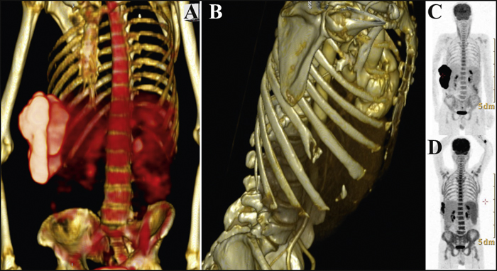 John Libbey Eurotext European Journal Of Dermatology Bone Involvement In Two Cases Of Thoracic Primary Cutaneous Diffuse Large B Cell Lymphoma Leg Type