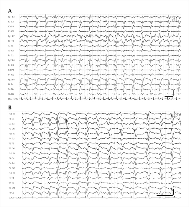 John Libbey Eurotext Epileptic Disorders Ambulatory Non Convulsive Status Epilepticus Evolving Into A Malignant Form