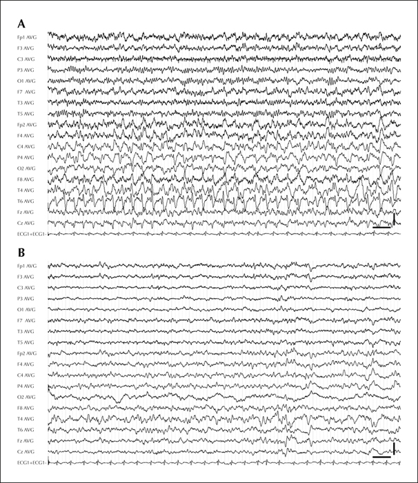 John Libbey Eurotext Epileptic Disorders Ambulatory Non Convulsive Status Epilepticus Evolving Into A Malignant Form