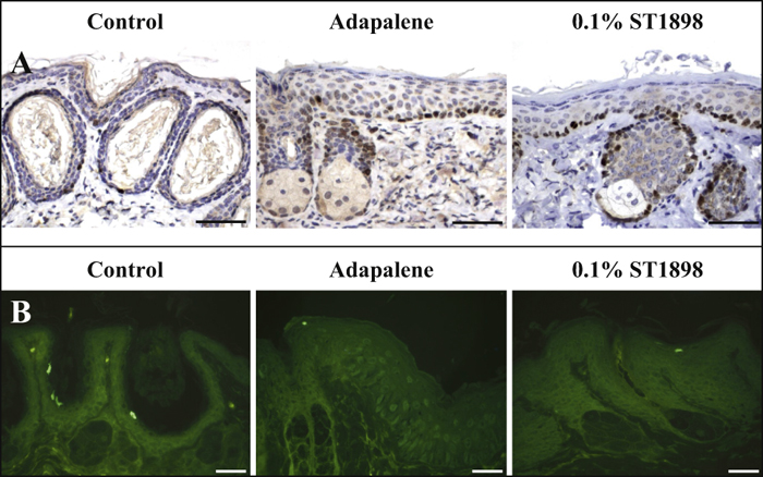 John Libbey Eurotext European Journal Of Dermatology The Atypical Retinoid E 3 3 Adamantan 1 Yl 4 Methoxybiphenyl 4 Yl 2 Propenoic Acid St18 Displays Comedolytic Activity In The Rhino Mouse Model