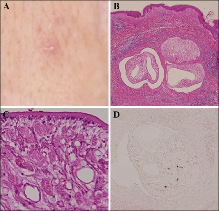 John Libbey Eurotext European Journal Of Dermatology Sparganosis Mansoni On Abdominal Skin Mimicking Folliculitis And Diagnosed By Analysis Of The Mitochondrial Cytochrome C Oxidase Subunit 1 Gene Using Polymerase Chain Reaction