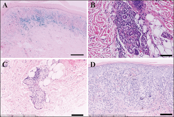 John Libbey Eurotext - Lichen Aureus: Clinicopathological Features In A 