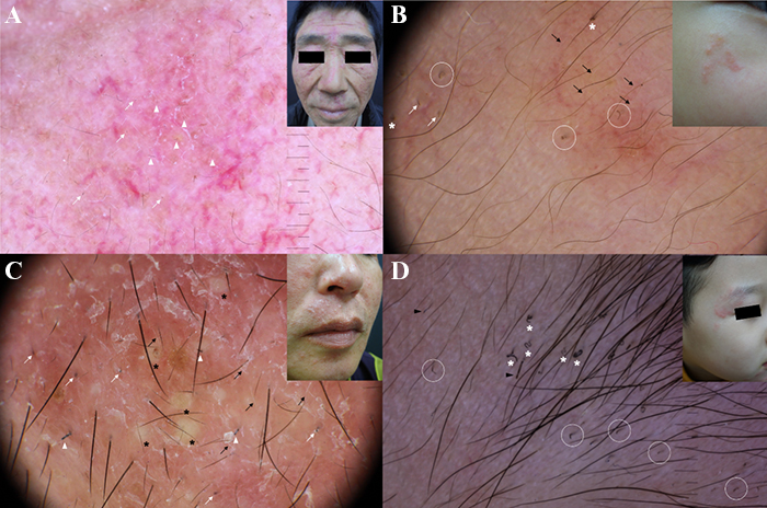 Jle European Journal Of Dermatology Facial Tinea Incognito A