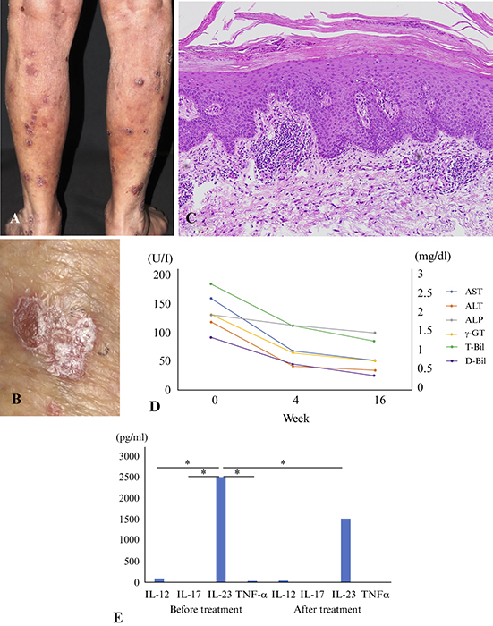 Jle European Journal Of Dermatology Psoriasis Vulgaris Associated