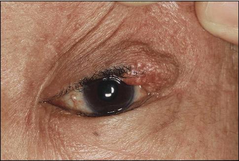 Tumor Eyelid