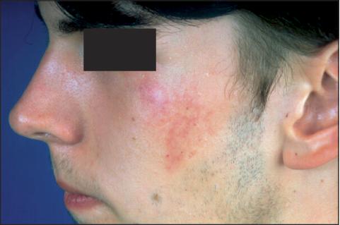 Nevus Flammeus Pictures