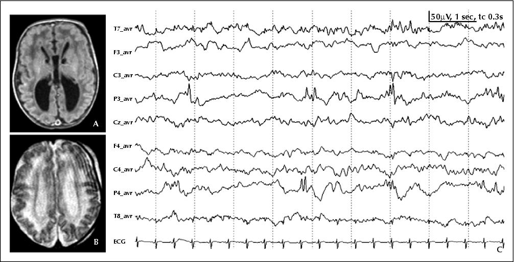 Figure 5 A) T1w and B) T2w MRI of an infant with Zellweger syndrome 