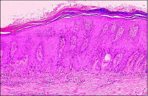 Psoriasis Histology