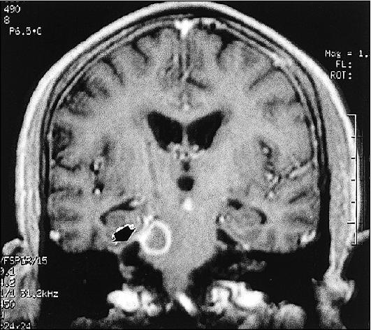 Irm Cerebral