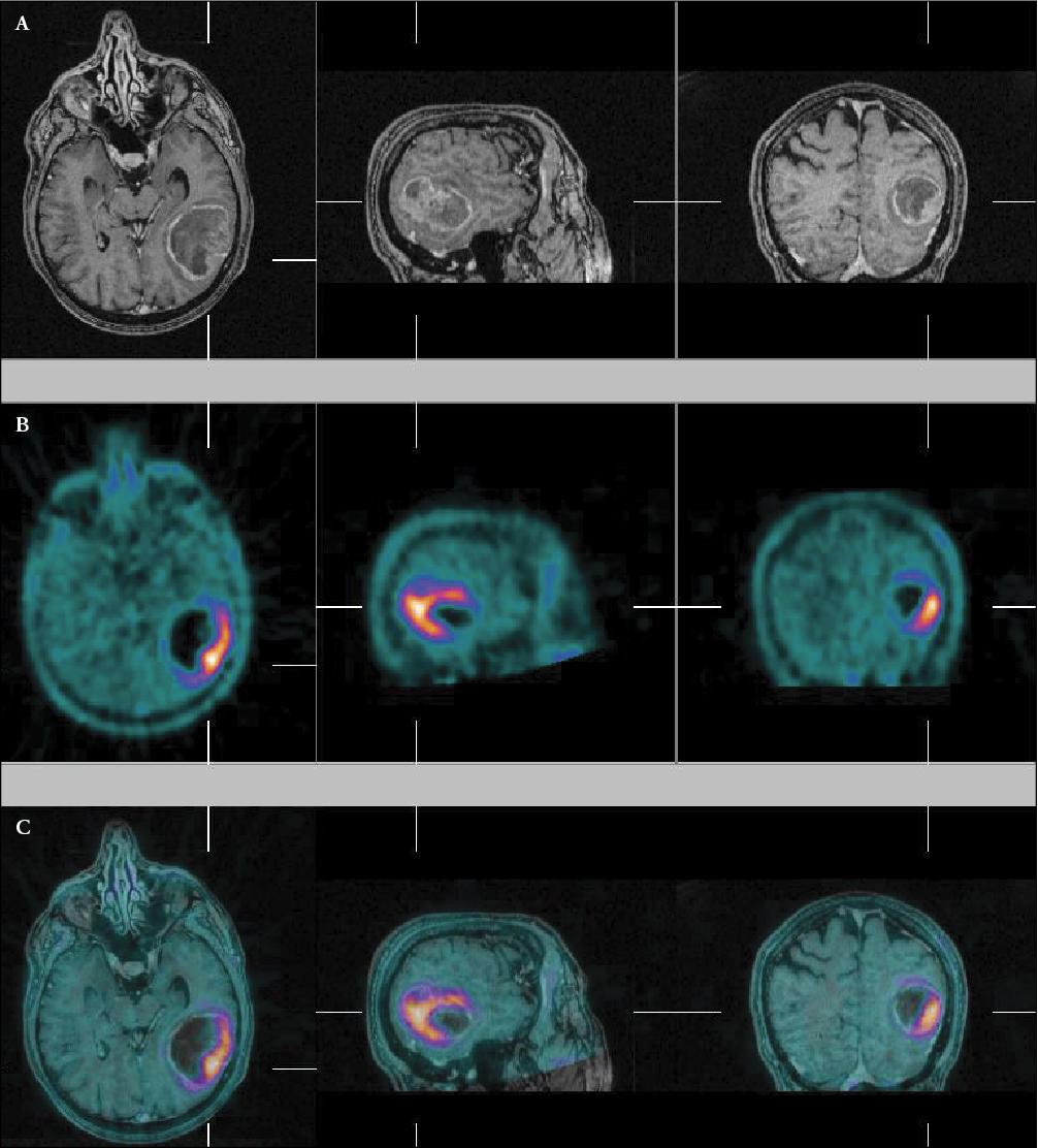 Irm Cerebral