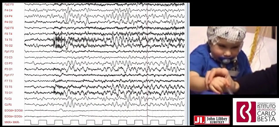 Paroxysmal tonic upgaze in a child with SCN8A-related encephalopathy