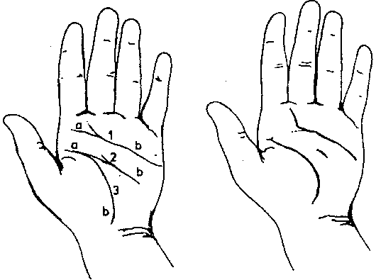fetal alcohol syndrome hands