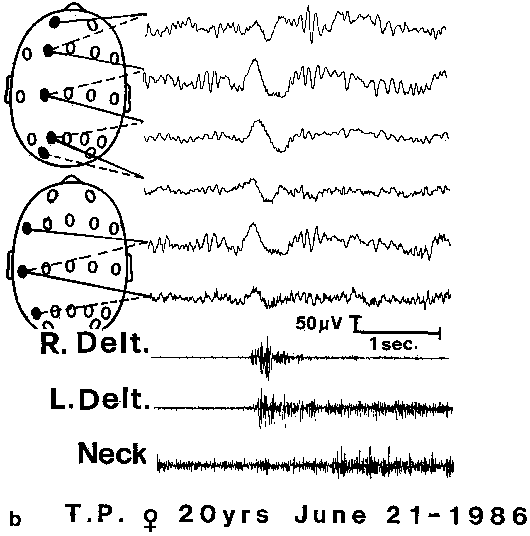 John Libbey Eurotext Epileptic Disorders Clinical And Video