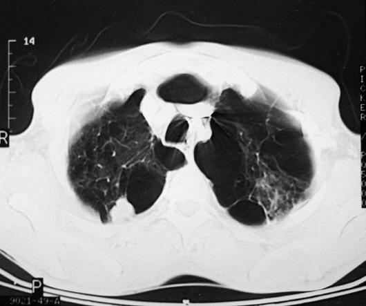 John Libbey Eurotext Medecine Therapeutique Metastases Cerebrales Revelant Un Cancer Sur Emphyseme Bulleux