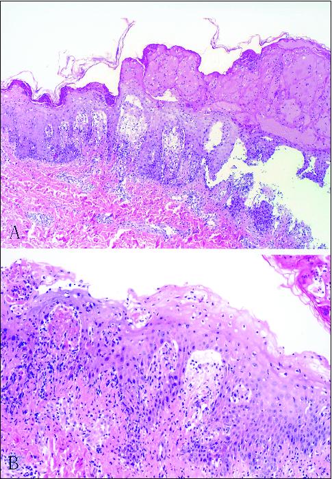 John Libbey Eurotext European Journal Of Dermatology Febrile Ulceronecrotic Mucha Habermann Disease With Extensive Skin Necrosis In Intertriginous Areas