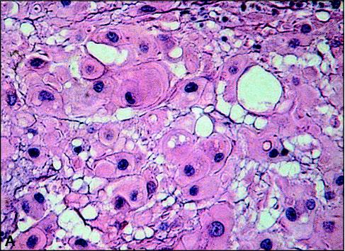 John Libbey Eurotext European Journal Of Dermatology Chordoma Cutis