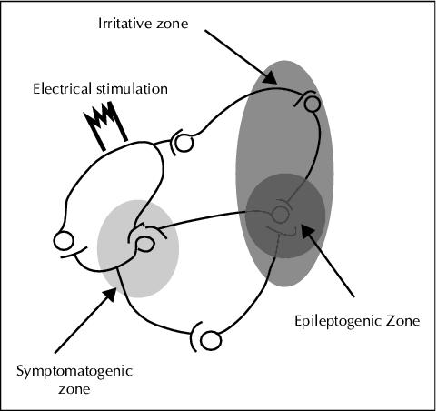 JLE - Epileptic Disorders - A Critical Review Of The Different ...