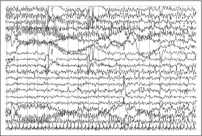 John Libbey Eurotext Epileptic Disorders Ictal Kissing And