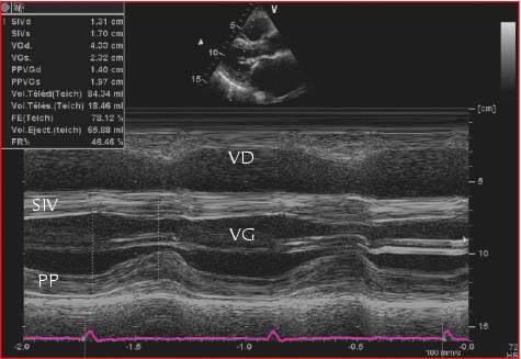 John Libbey Eurotext Medecine Therapeutique Cardiologie Place De L Echocardiographie Dans La Fibrillation Auriculaire