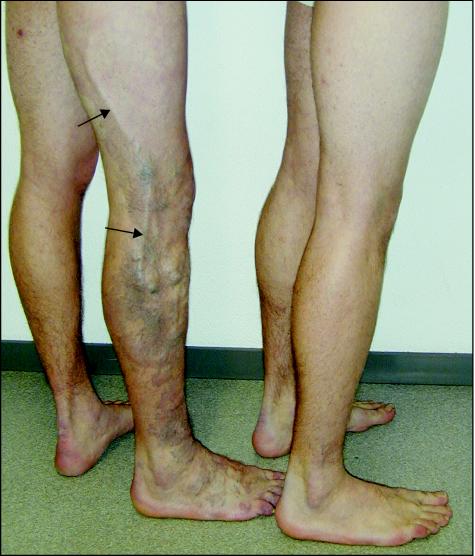 Klippel Trenaunay Syndrome