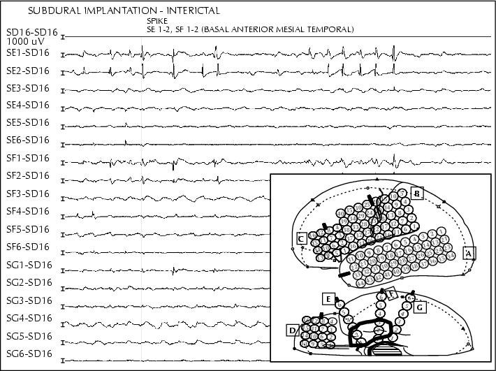 John Libbey Eurotext Epileptic Disorders A Case Of Auditory Auras