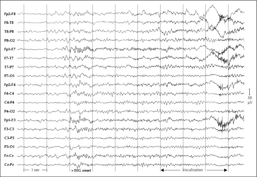 John Libbey Eurotext Epileptic Disorders Frontal Lobe Epilepsy