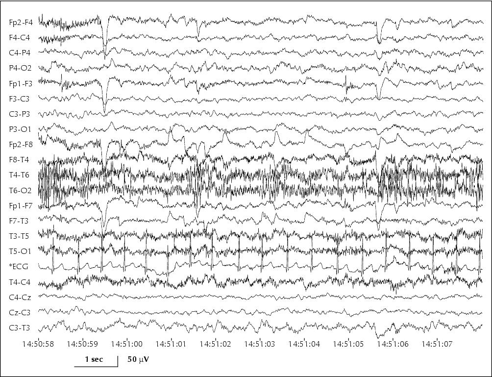 John Libbey Eurotext Epileptic Disorders Euphoric Hedonic Theta Hypersynchrony In Early Childhood