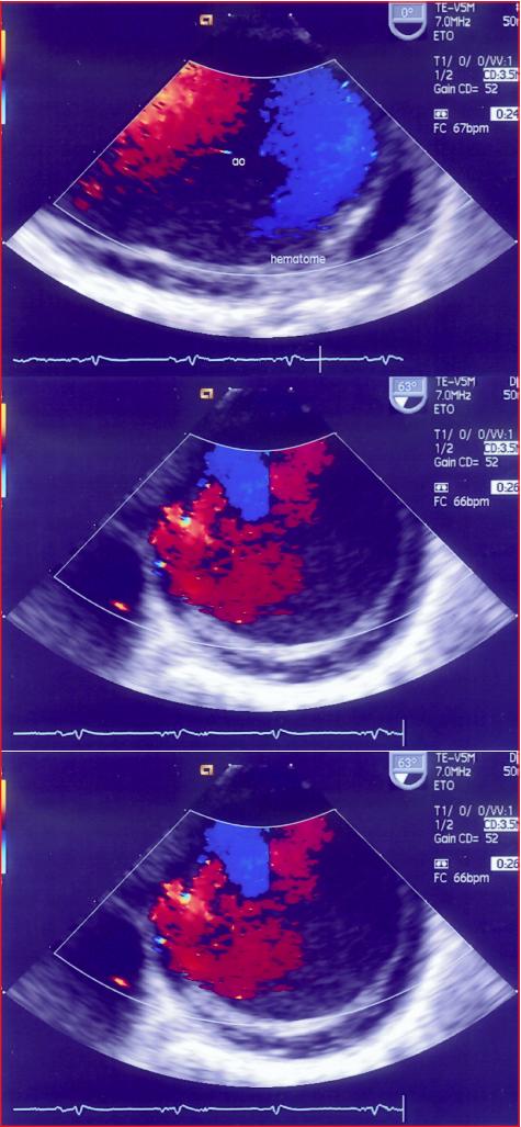 John Libbey Eurotext Mt Cardio Hematome Intraparietal Aortique