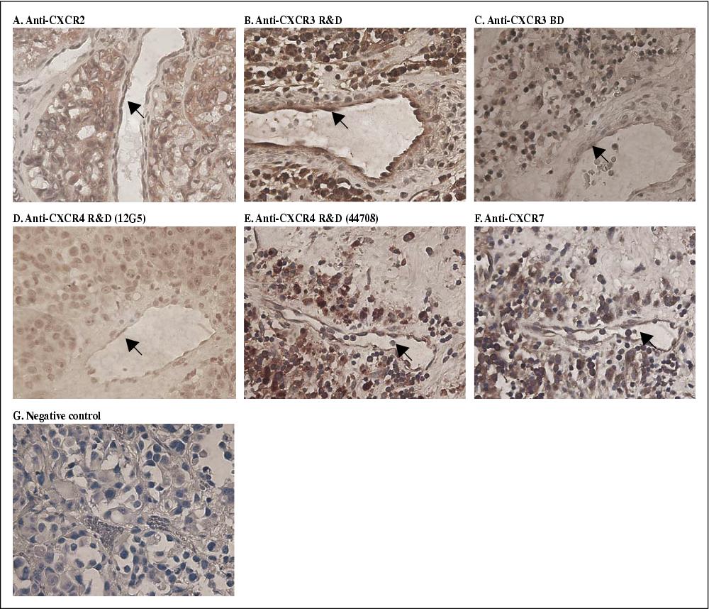 John Libbey Eurotext European Cytokine Network Hypoxia Enhances Cxcr4 Expression In Human Microvascular Endothelial Cells And Human Melanoma Cells